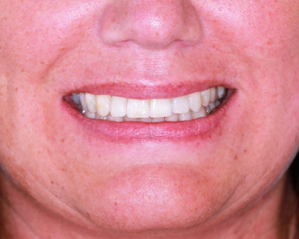 Powerprox 6 Months Braces and Dental Implants Private Dentistry
