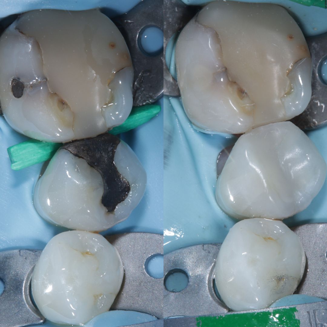 Amalgam fillings replaced with composite Private Dentistry