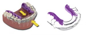 The squeeze effect of the two aligner bows on the front teeth