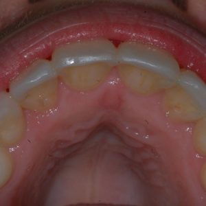 Minimal damage to the teeth and supporting structures