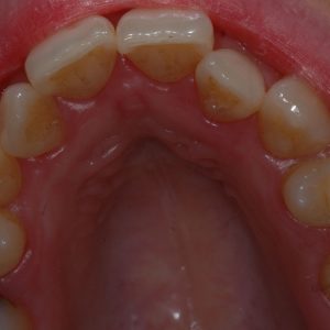 Misalignment of teeth