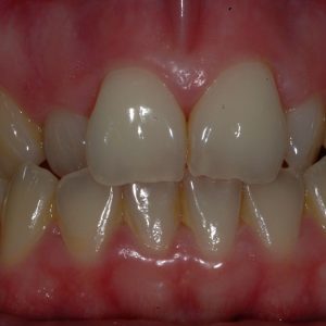 Unhappy with misalignment of teeth