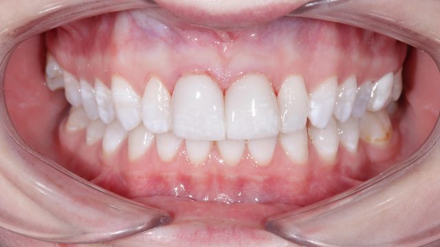 Teeth Whitening and Veneers