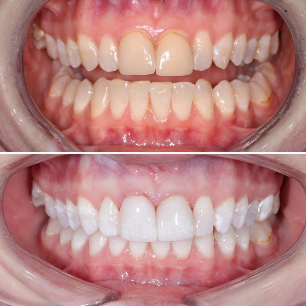 Teeth Whitening and Veneers Private Dentistry