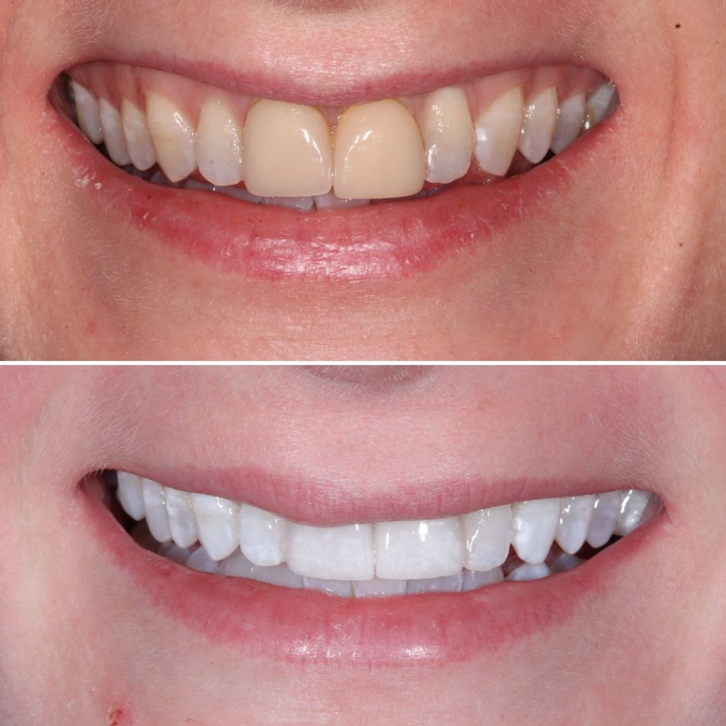 Teeth Whitening and Veneers Private Dentistry