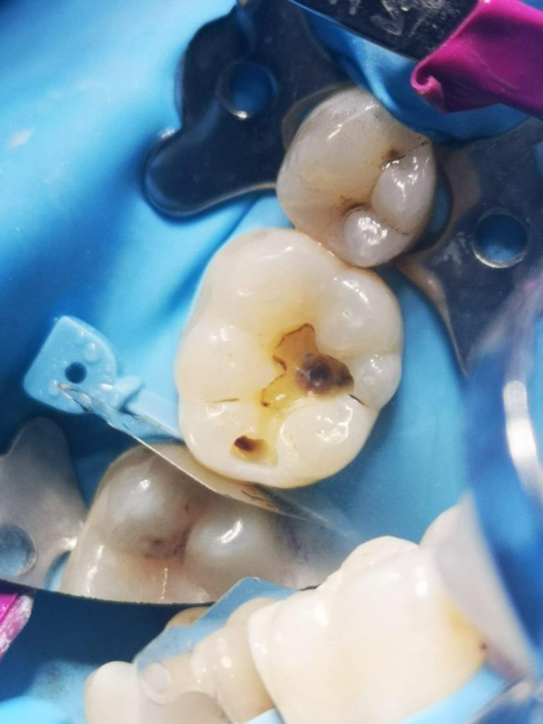 Amalgam filling replacement with composite Private Dentistry