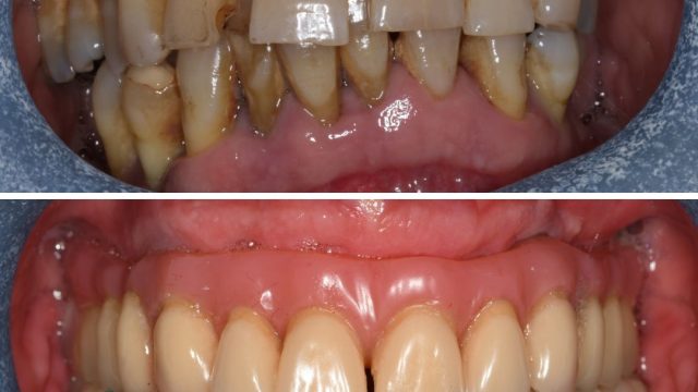 Upper and Lower Arch Implant Solution – By Finley Bason