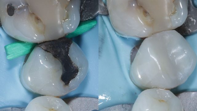 Amalgam fillings replaced with composite