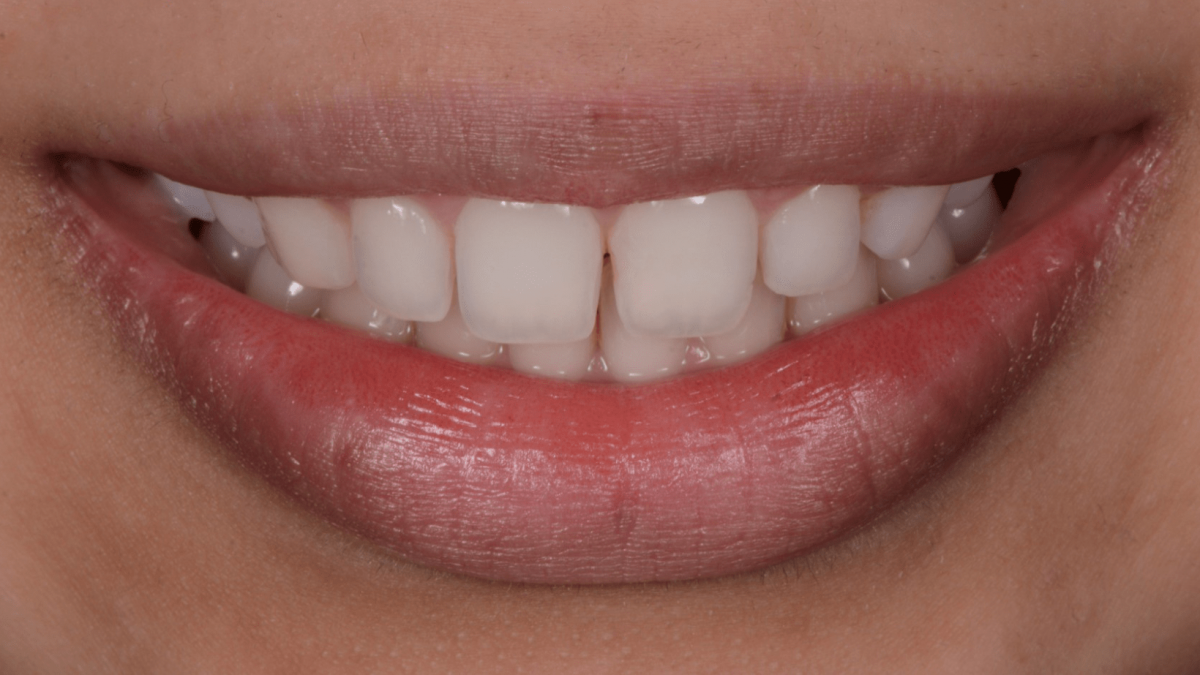 Orthodontics and composite bonding Private Dentistry