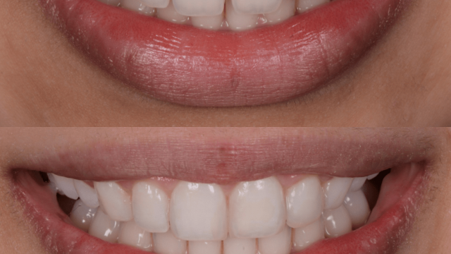 Orthodontics and composite bonding